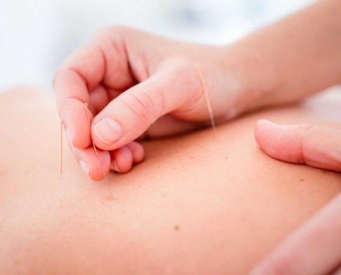 Akupunktur bei Kinemedic - Praxis für physikalische und rehabilitative Medizin
